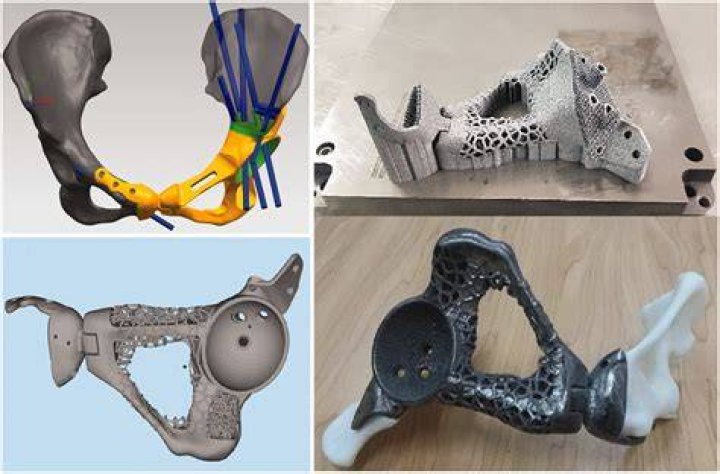 3D Printed Pelvic Implants from Onkos Surgical Earn FDA Clearance