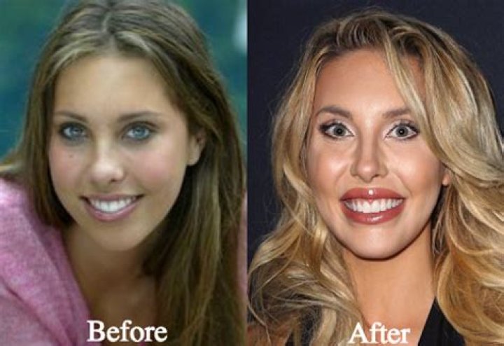 Chloe Lattanzi before and after plastic surgery (Photos) 3 Chloe Lattanzi Plastic Surgery Before and After Photos