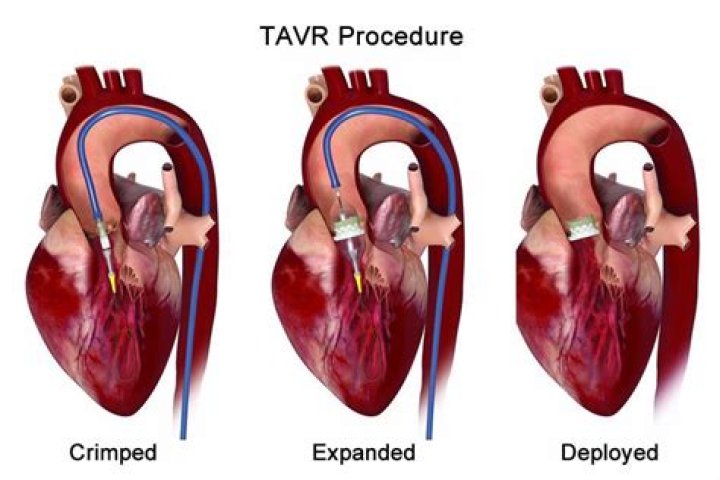 New TAVR Program starts at Good Samaritan Hospital, Westchester Medical Center