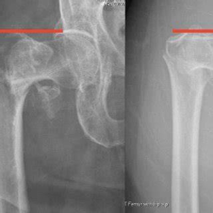 Varus Displacement of Intertrochanteric Femur Fractures on Injury Radiographs Is Associated with Screw Cutout